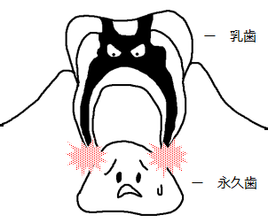 乳歯のむし歯